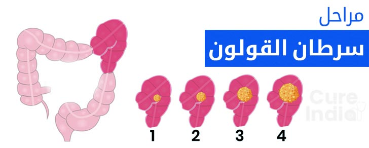 مراحل سرطان القولون